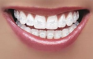 ceramic_braces_middletown_ny