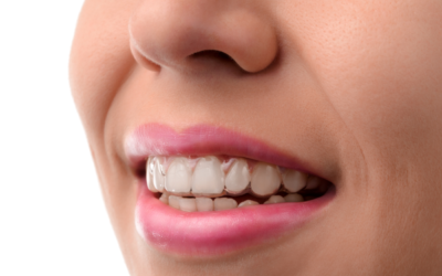 Four Benefits of Treatment with Invisalign