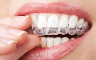 Invisalign Vs. Smile Direct Club