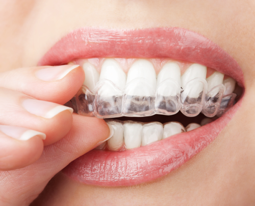 Invisalign Vs. Smile Direct Club