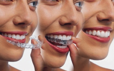 How To Make Invisalign More Comfortable