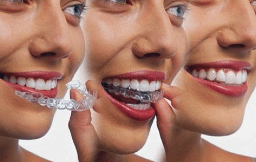 how to make invisalign more comfortable middletown ny