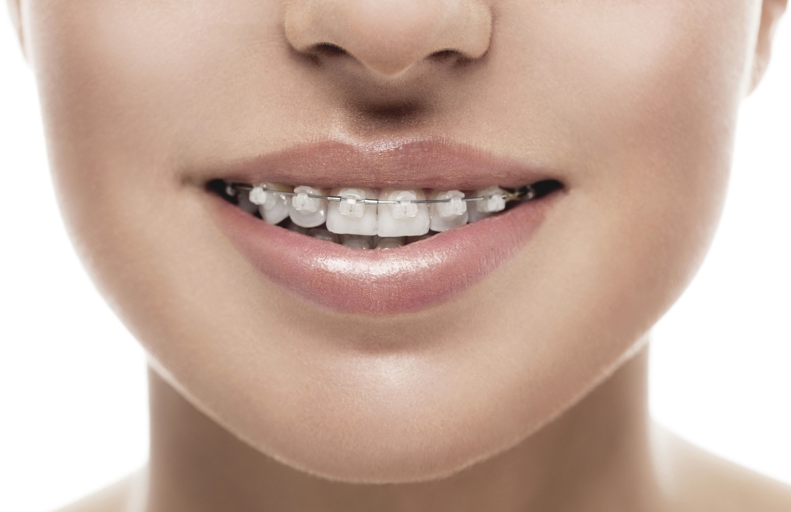 What is the Average Cost for Orthodontic Braces?