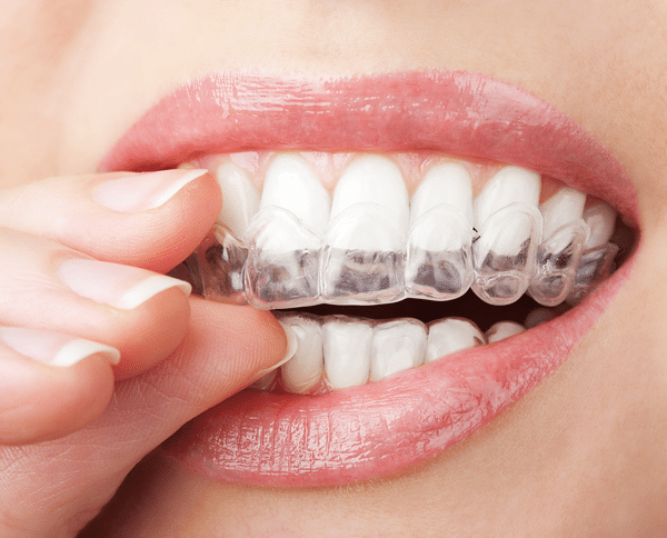 invisalign in orange county