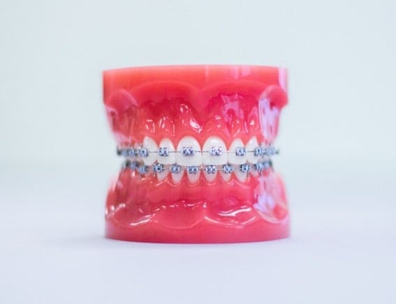 treatment-metal-braces