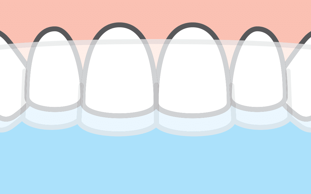 How to Properly Insert Invisalign Aligners