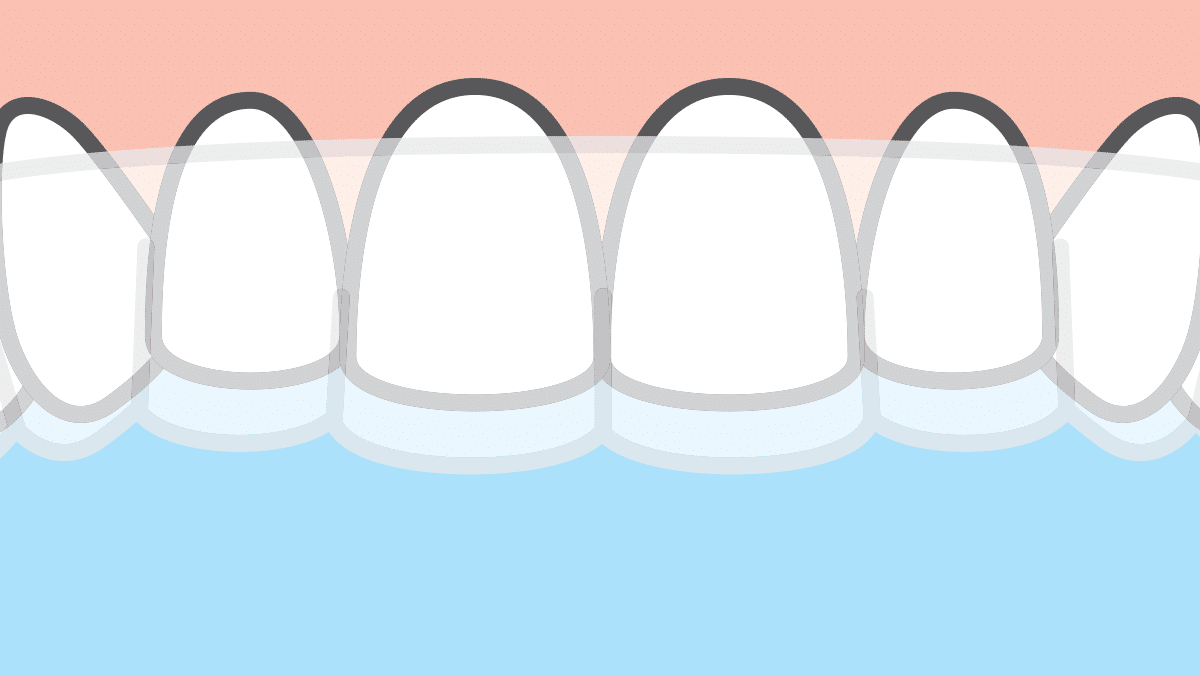 How to Properly Insert Invisalign Aligners