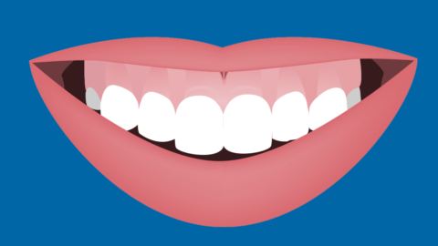 How to Fix a Gummy Smile with Braces - bracesetters