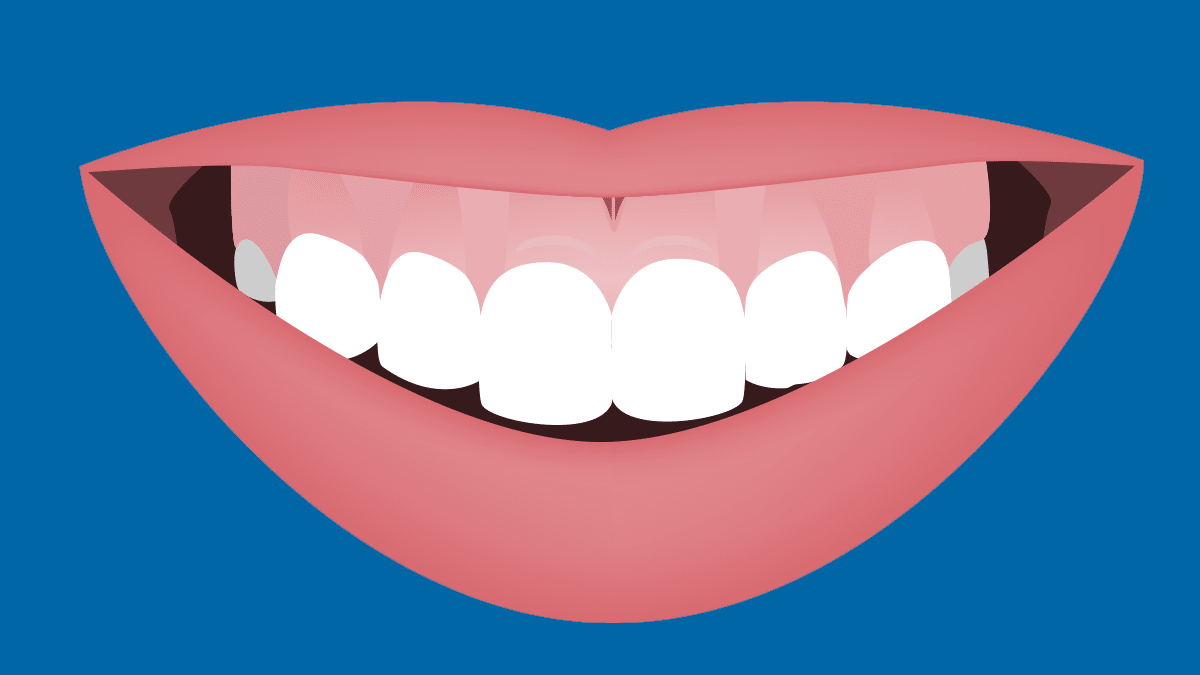How to Fix a Gummy Smile with Braces