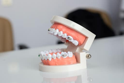 Common Issues That Braces Can Fix