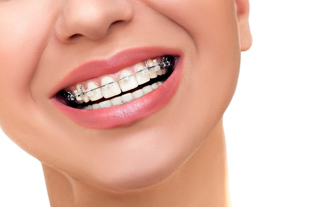 16 Myths and Facts About Braces