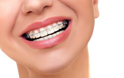 16 Myths and Facts About Braces