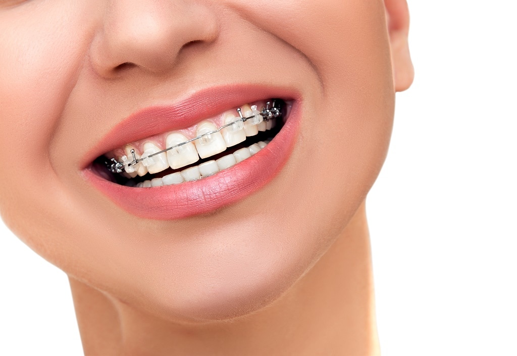 Myths and facts about braces