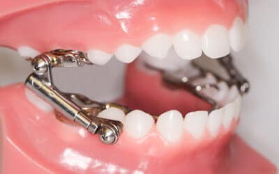 How much do braces cost?