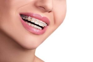 What Can Braces Fix? 