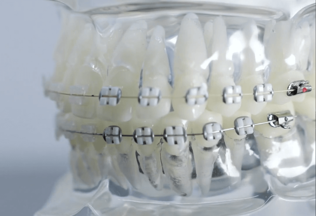 Myths and facts about braces