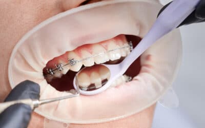 The Average cost of Braces and How to Save