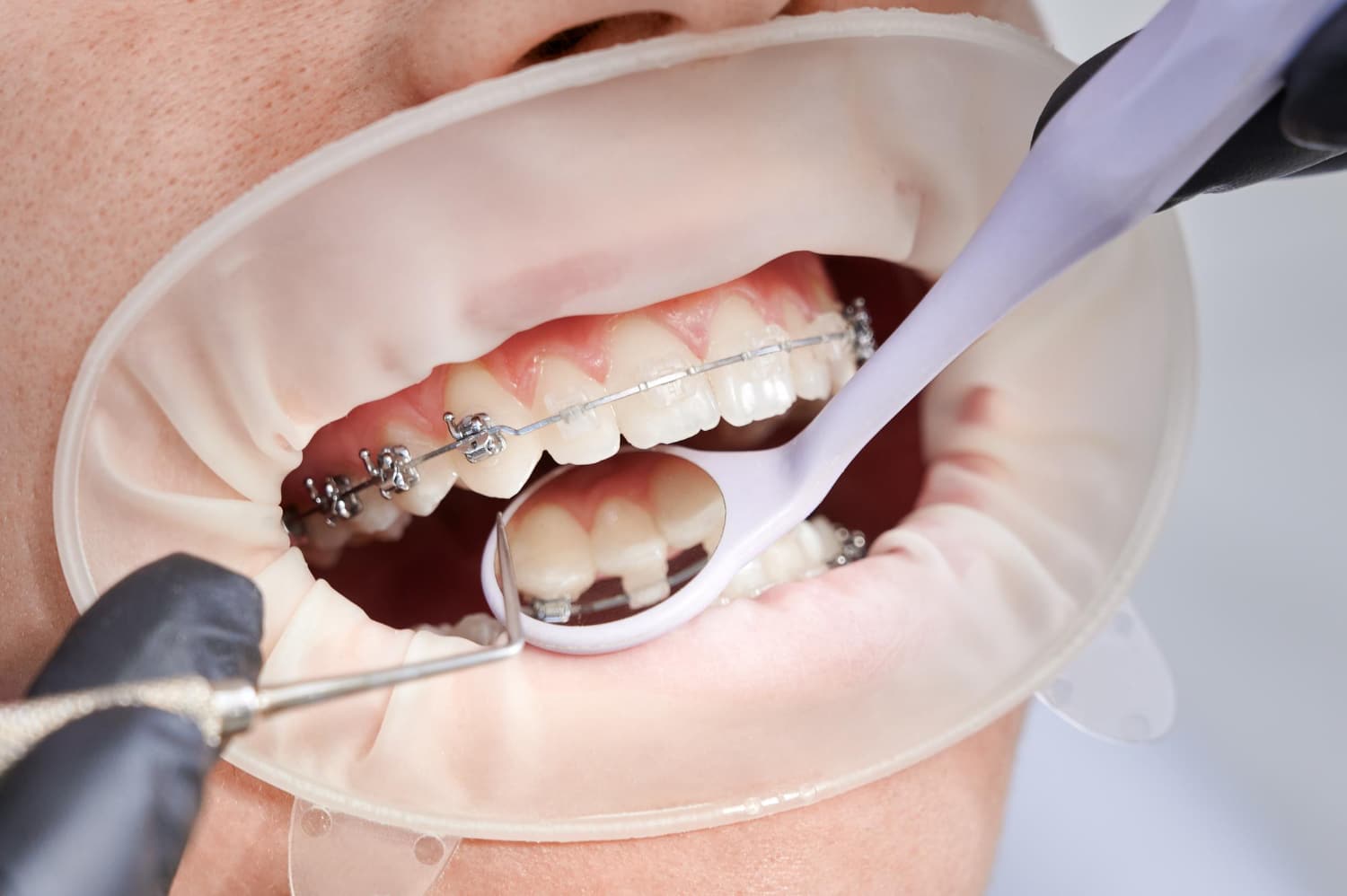 average cost of braces
