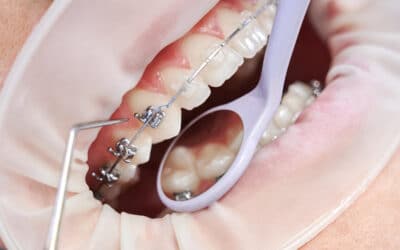 Top Braces Options for a Perfect Smile