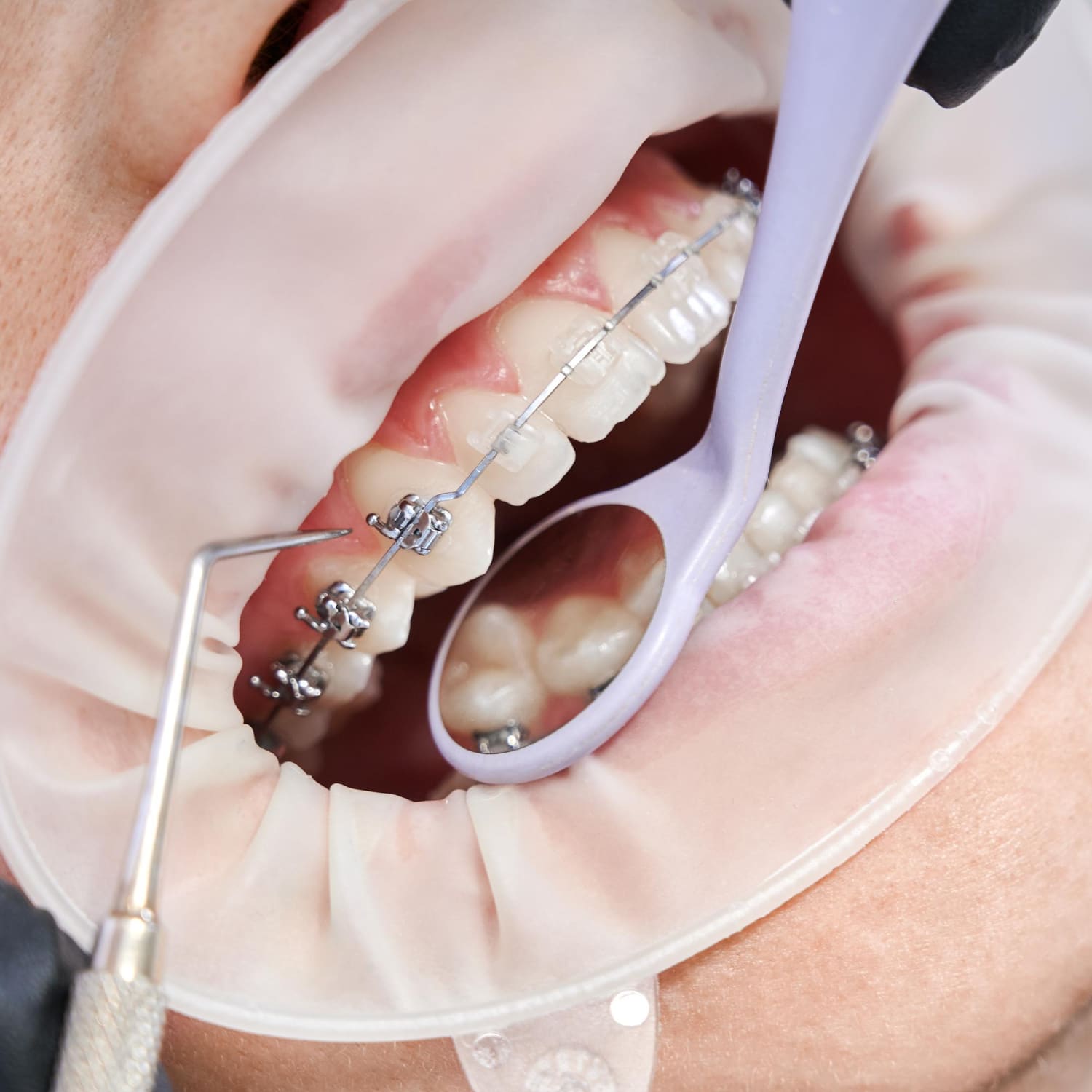 dental insurance for braces