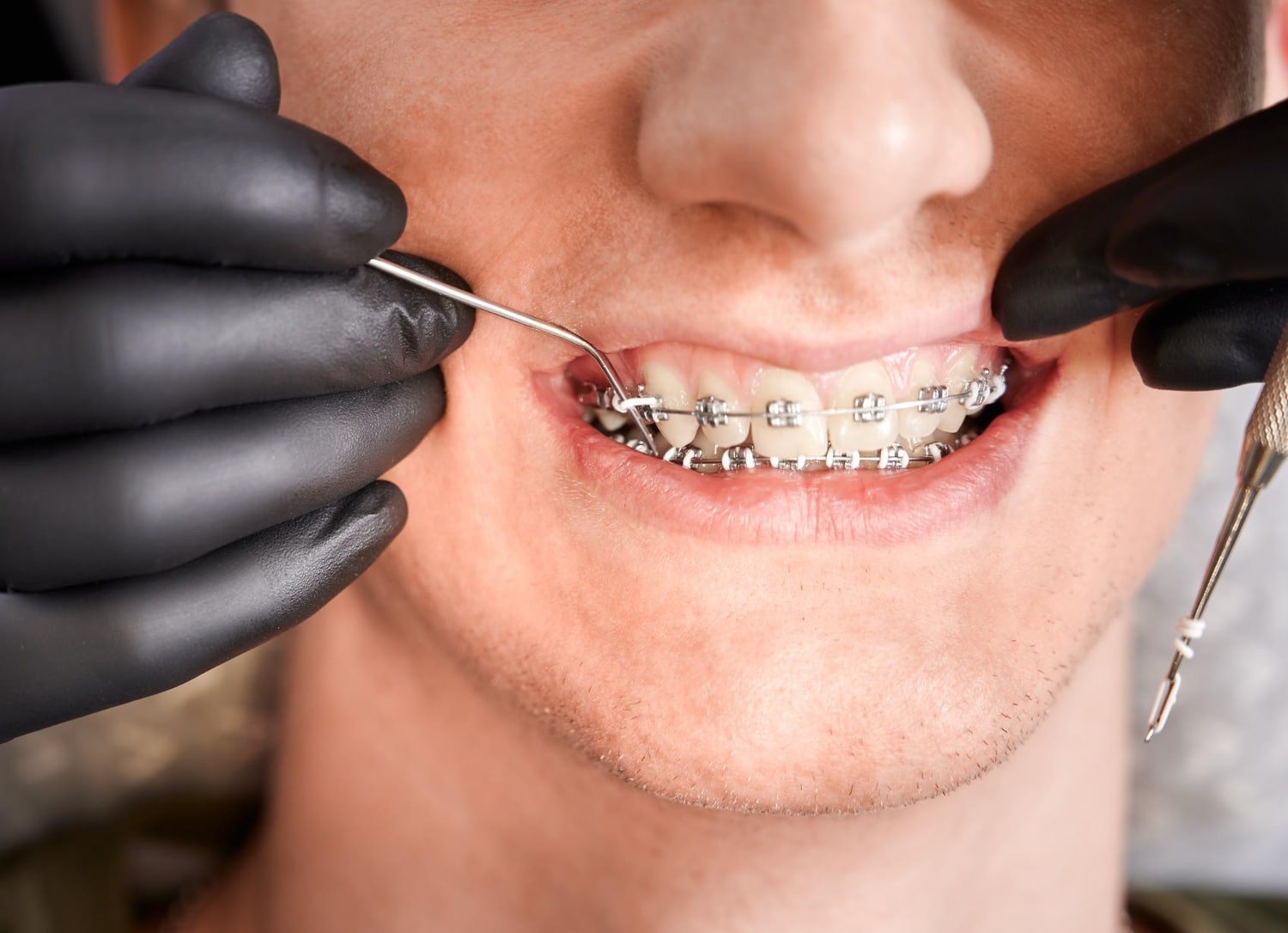 Cost to Get Braces in New York 2023: Experts Ultimate Guide