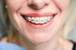 aligners vs. braces
