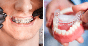 Invisalign Treatment Explained: The Ultimate Guide to a Better Smile