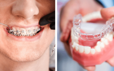 Choosing Your Path to a Perfect Smile: Aligners or Braces?