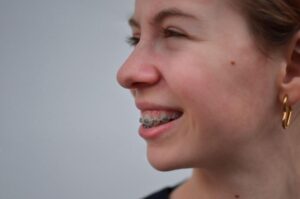 Keeping Up with Braces Care While Sick in Monticello